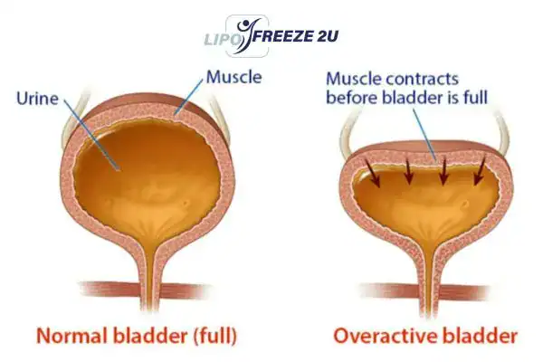 diagram of overactive bladder treatment Solihull
