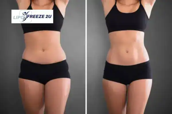 How Can LIPO FREEZE 2U Support Your Post-Pregnancy Body Recovery Solihull?