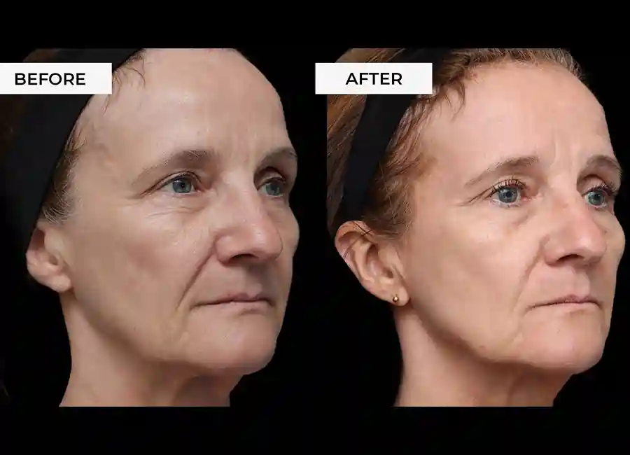 How Many RF Microneedling Sessions Will You Need to See a Difference Solihull?