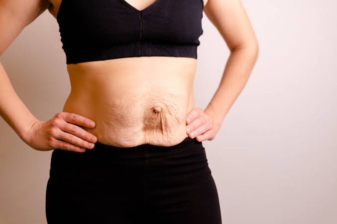 Is Surgery Really the Only Way to Repair Diastasis Recti Solihull?